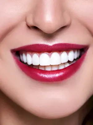 Виниры на зубы голливудская улыбка